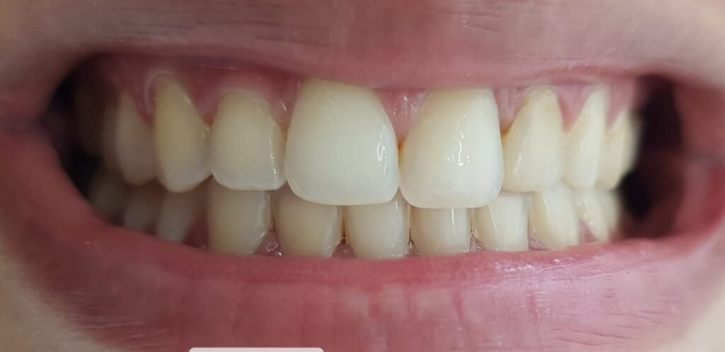 clareamento dental